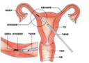 女性如何治疗输卵管粘连